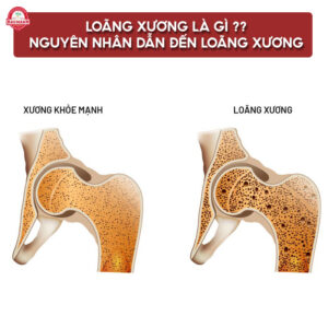 Loãng xương là gì? Nguyên nhân dẫn đến loãng xương